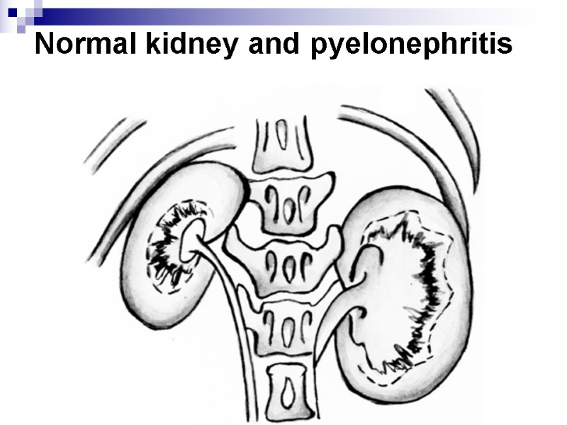 Normal kidney and pyelonephritis